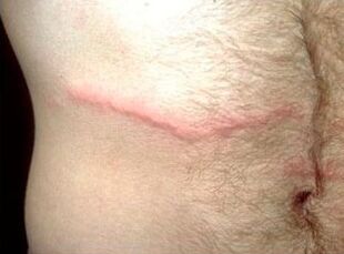 how to get rid of subcutaneous parasites in humans