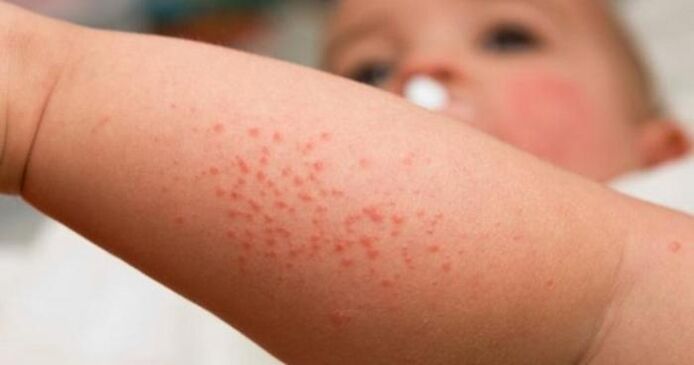 skin rash as a symptom of parasite infection