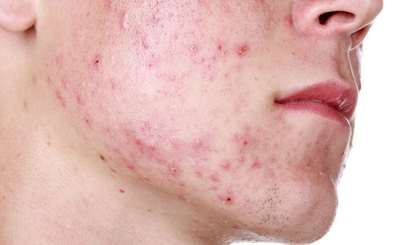 rash on the face caused by parasites