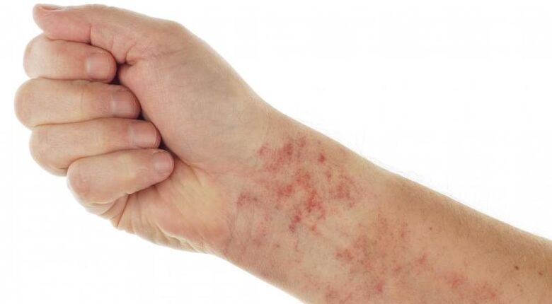 skin rashes in the presence of parasites in the body